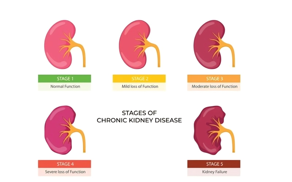 kidney transplant in India